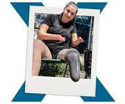 Luxmed - Get Above Knee Prosthetic Leg in ukraine